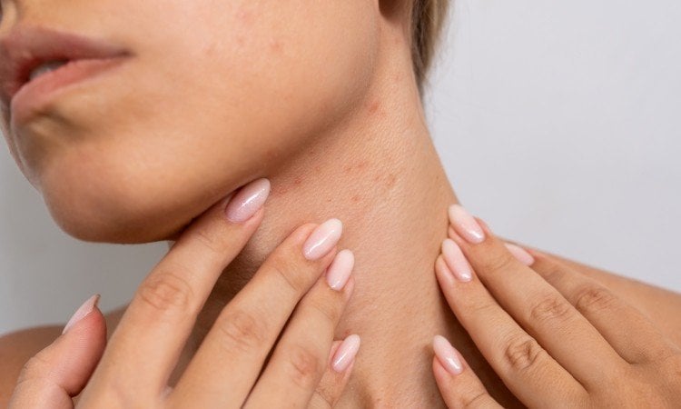 Nahaufnahme von Kinn und Hals; eine Person berührt mit beiden Händen den Hals, auf der Haut sind kleine gerötete Stellen zu sehen