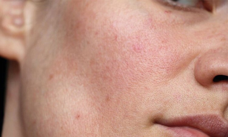 Nahaufnahme eines Gesichts auf der die Poren und Rötungen zu sehen sind
