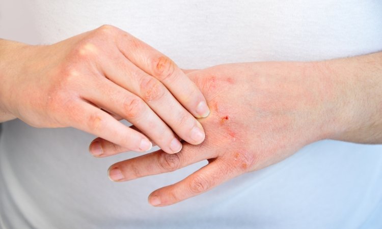 Nahaufnahme von Händen; eine Person juckt kleine Kratzwunden an den Handknöcheln