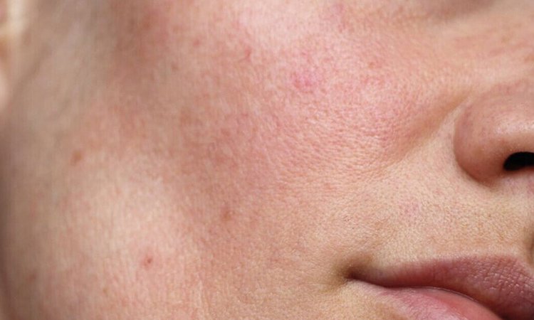 Nahaufnahme kleiner Hautrötungen auf der Wangenpartie des Gesichts Nahaufnahme kleiner Hautrötungen auf der Wangenpartie des Gesichts