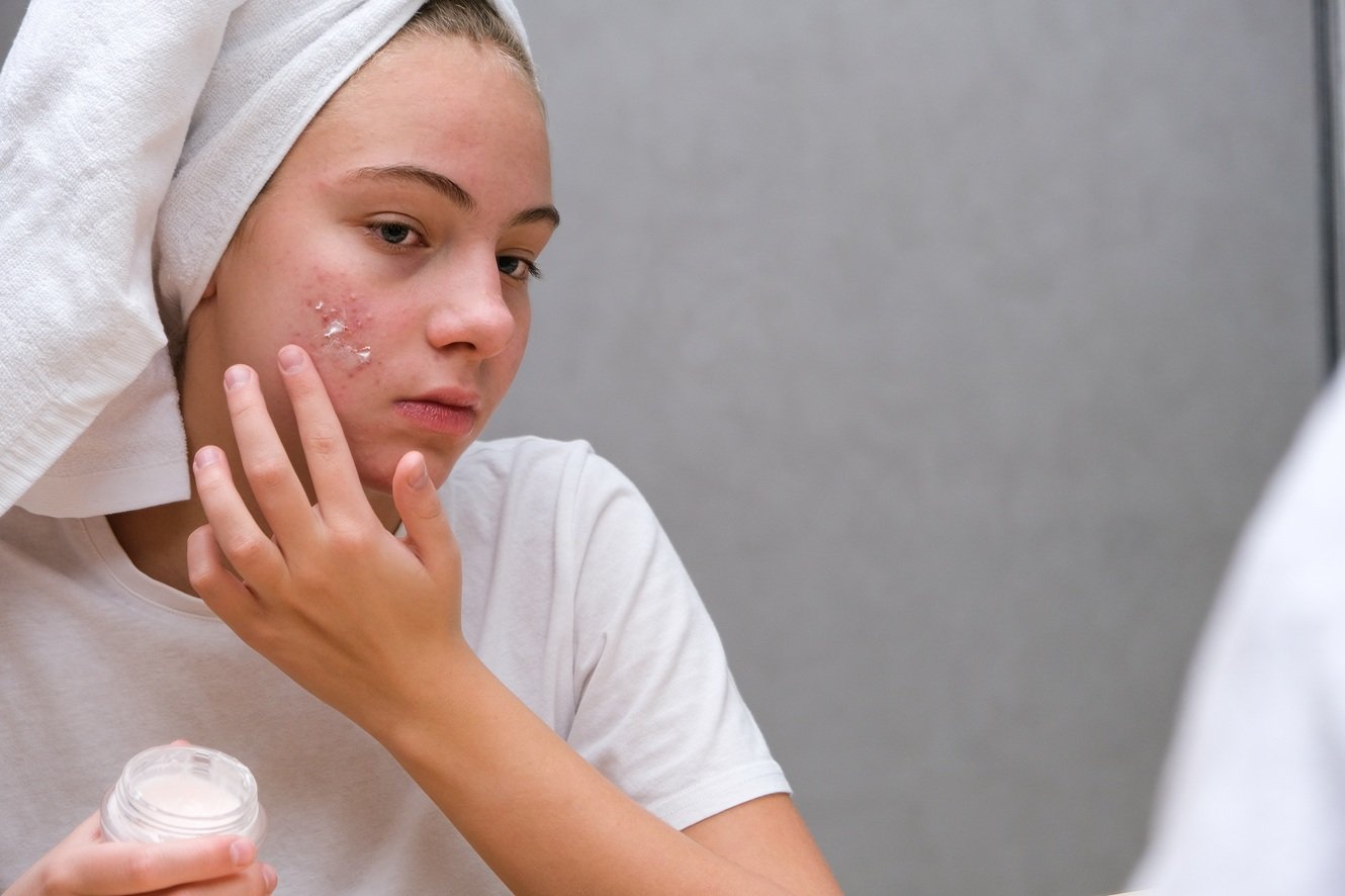 Jugendliche Person mit Handtuch um den Kopf trägt Creme auf eine gerötete, unreine Stelle an der Wange auf und schaut in den Spiegel