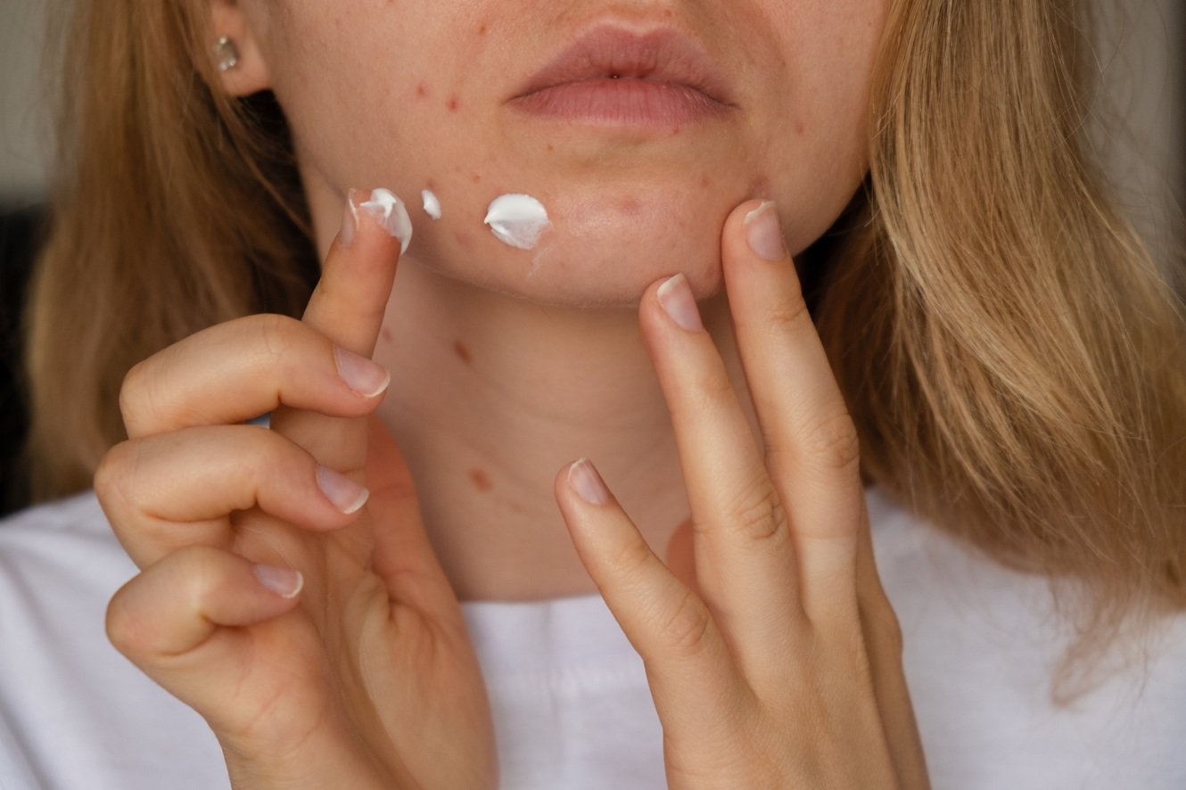 Nahaufnahme des unteren Gesichts einer Frau, die mit den Fingern weiße Creme auf einen Pickel am Kinn aufträgt.