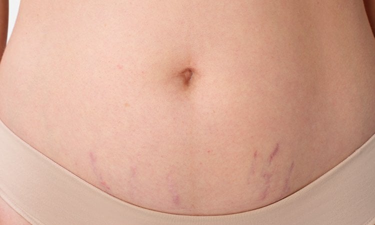 Schwangerschaftsstreifen am unteren Bauch