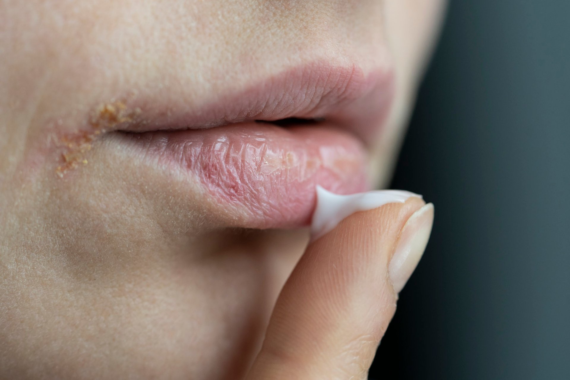 Nahaufnahme von rissigen, trockenen Lippen; Person berührt die Lippe mit dem Finger.