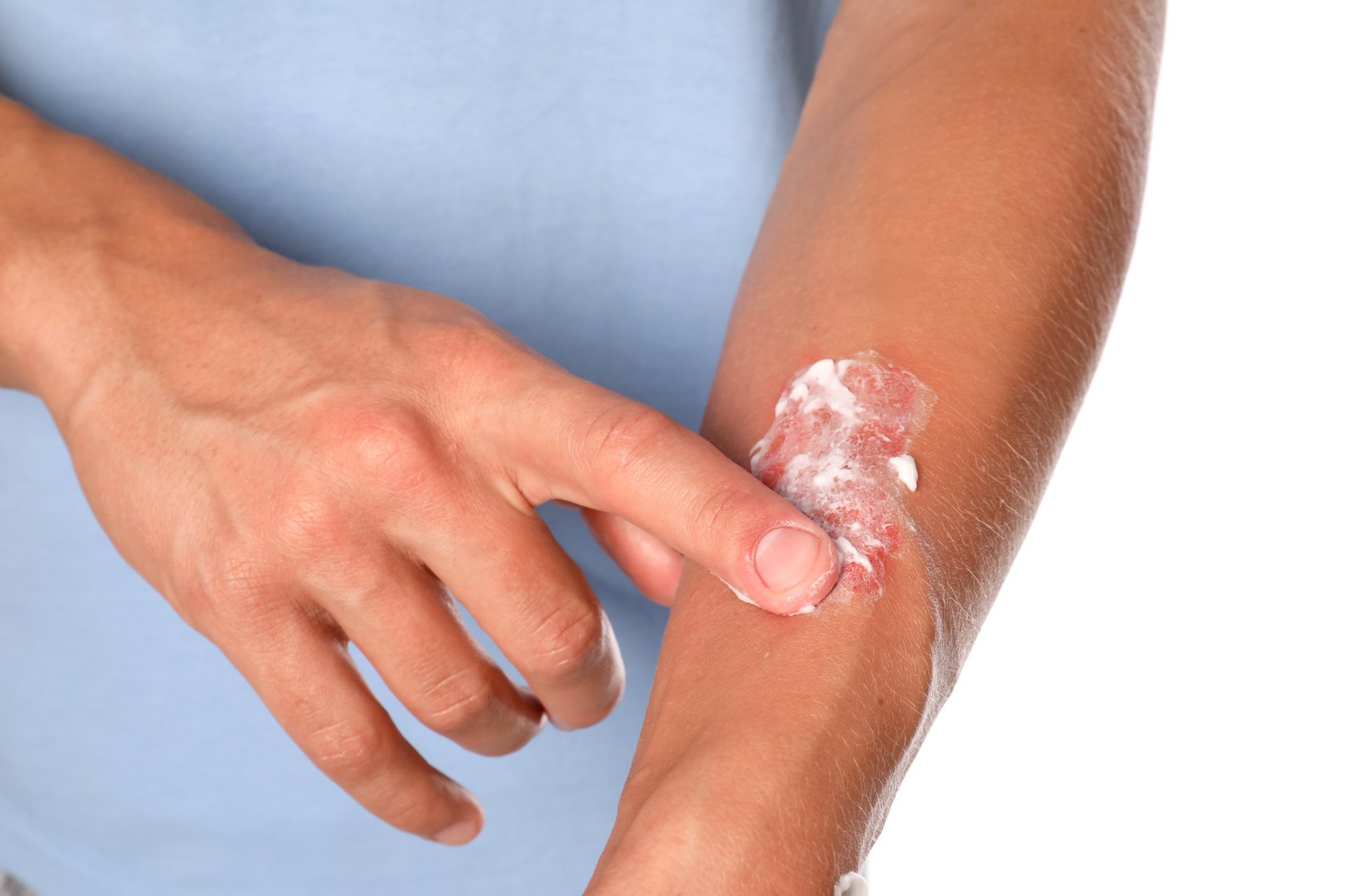 Nahaufnahme einer Person, die sich mit einem Finger Creme auf den Arm aufträgt