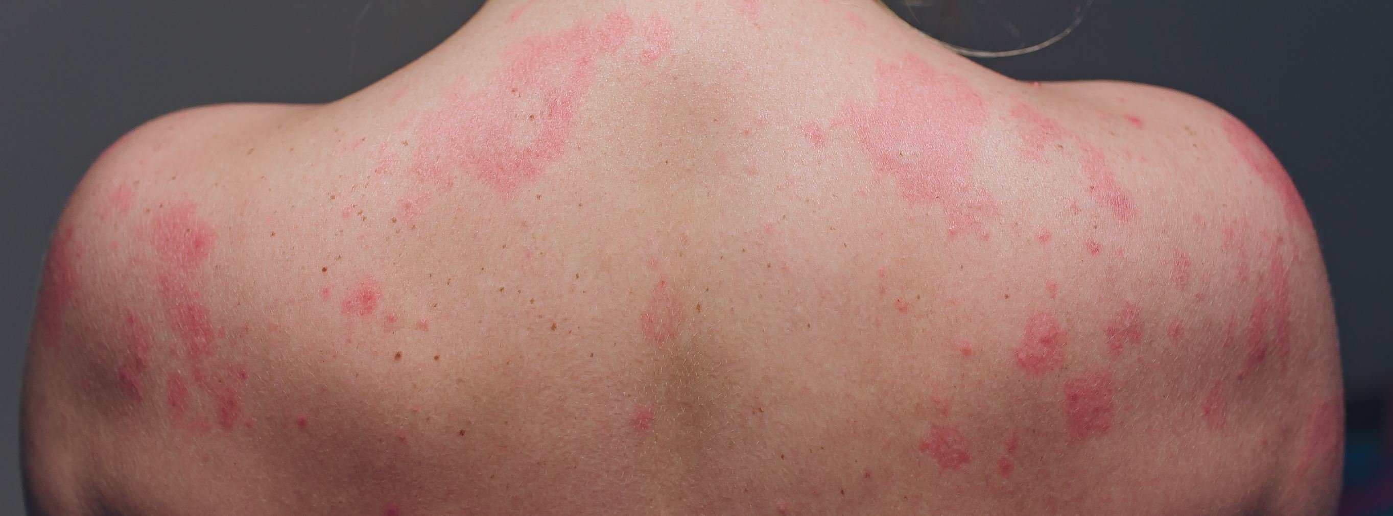 Ekzem: Formen, Ursachen und was der Haut bei Schüben hilft Oberer Rücken und Schulterbereich mit roten Stellen