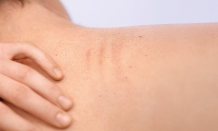 Rückenbereich mit einigen Stellen unreiner Haut
