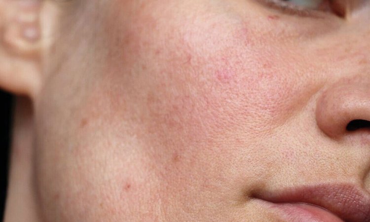 Nahaufnahme kleiner Hautrötungen auf der Wangenpartie des Gesichts