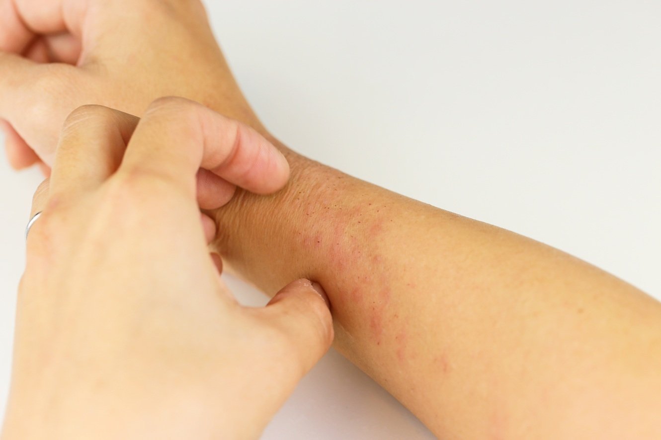 Nahaufnahme einer Hand, die eine Stelle am anderen Arm kratzt