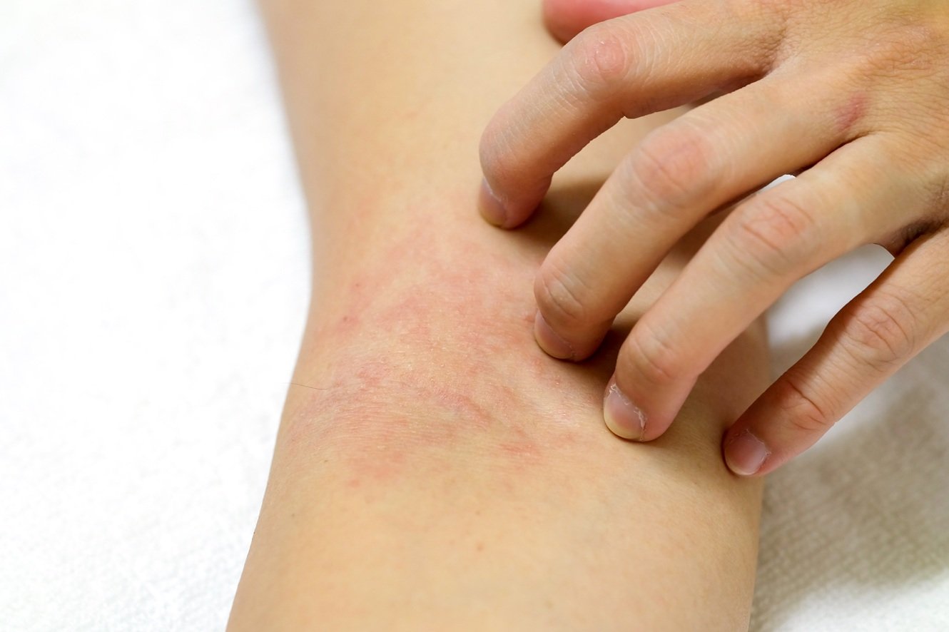 Nahaufnahme einer Stelle am Arm, die von der Hand gejuckt wird