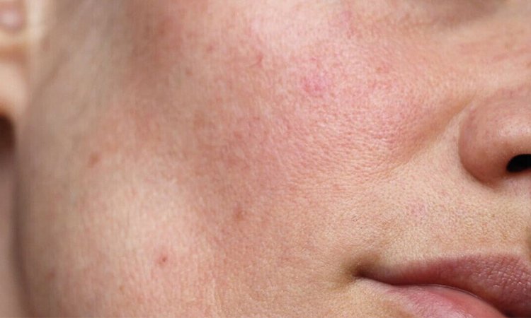 Gesichtshälfte einer Person mit Rötungen auf der Wangee