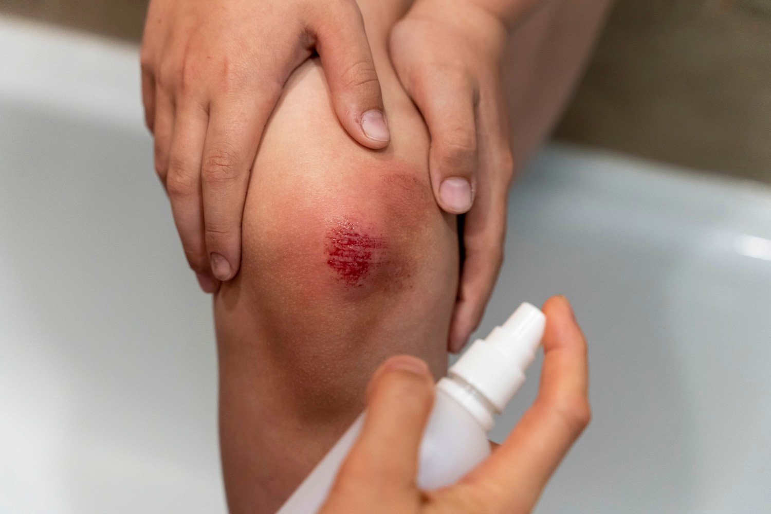 Hände halten ein Knie mit Wunde, Desinfiktionsspray wird darauf gesprüht